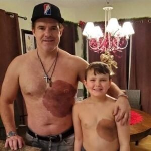 Dad Gets Matching Birthmark Tattoo